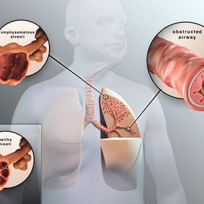 Management Of Obstructive Airway Disorders