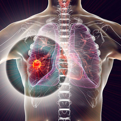 Lung Cancer Specialist in Hyderabad